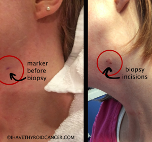 Lymph node biopsy incision sites